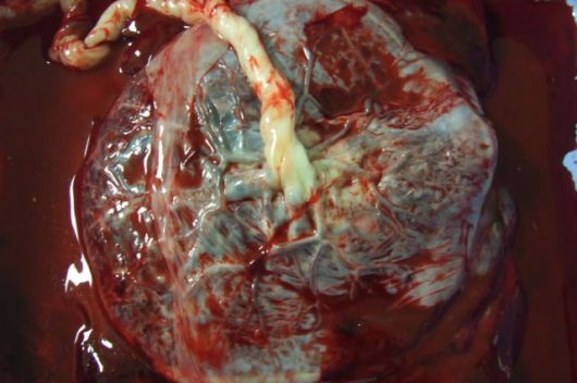 Menneskelig placenta