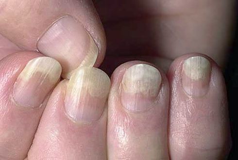 Peeling af neglepladen fra blødt væv