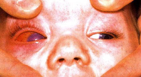 Endophthalmitis hos børn