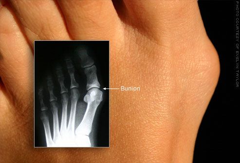 Bunion vulgus deformitet af storetåen