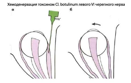 Strabismus - Operation