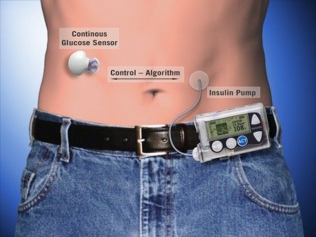 kunstig bugspytkirtel for diabetes