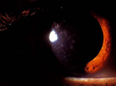Epidemisk keratokonjunktivitis