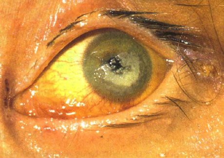 Bilateral keratitis forårsaget af Candida hos et barn med alvorlig immundefekt