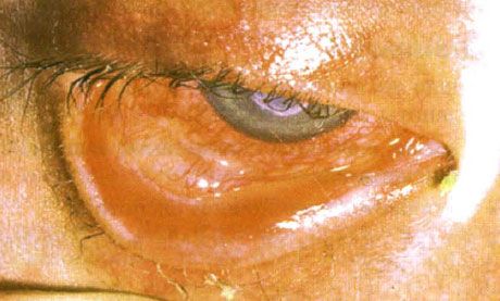 Stevens-Johnsons syndrom. Bilateral deskvamativ konjunktivitis med nekroseområder. Svær keratitis, som forårsagede ardannelse på hornhinden. Situationen blev kompliceret af tilføjelsen af tørre øjne-syndrom.
