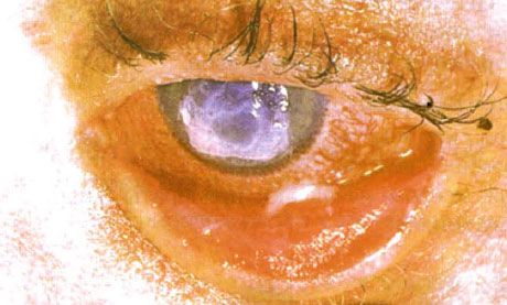 Stevens-Johnsons syndrom. Bilateral deskvamativ konjunktivitis med nekroseområder. Svær keratitis, som forårsagede ardannelse på hornhinden. Situationen blev kompliceret af tilføjelsen af tørre øjne-syndrom.