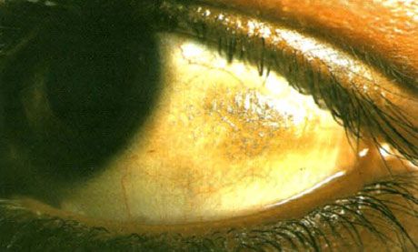 Xerophthalmos. Bitots plakker fremstår som hævede områder i bindehinden med aflejringer af flere skæl, placeret i det område, der ikke er dækket af øjenlågene. Som i dette tilfælde er de patologiske områder ofte pigmenterede.