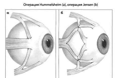 Strabismus - Operation