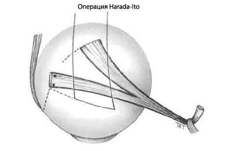 Strabismus - Operation