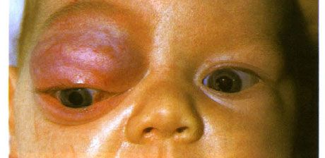 Kapillær hemangiom i den forreste del af bane og øvre øjenlåg.  Neoplasma har tendens til at udvikle sig