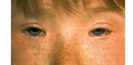 Syndrom af blepharophimosis.  Tosidet betjent ptosis, telecanthus og blepharophimosis