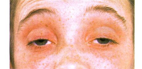 Ekstern oftalmoplegi. Bilateral ptose. Patienten åbner øjnene ved at hæve øjenbrynene.