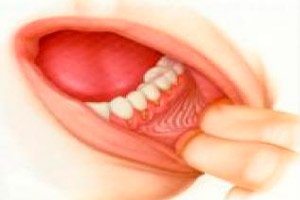 Kræft i mundhulen